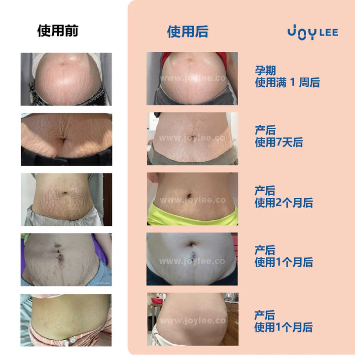 JOYLEE Radiance Stretch Mark Cream - 160ml