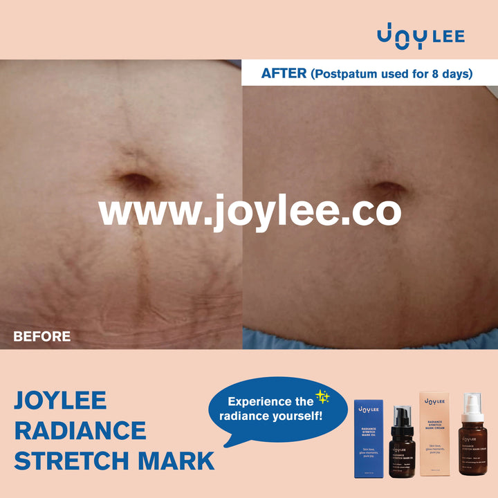 JOYLEE Radiance Stretch Mark Cream - 160ml