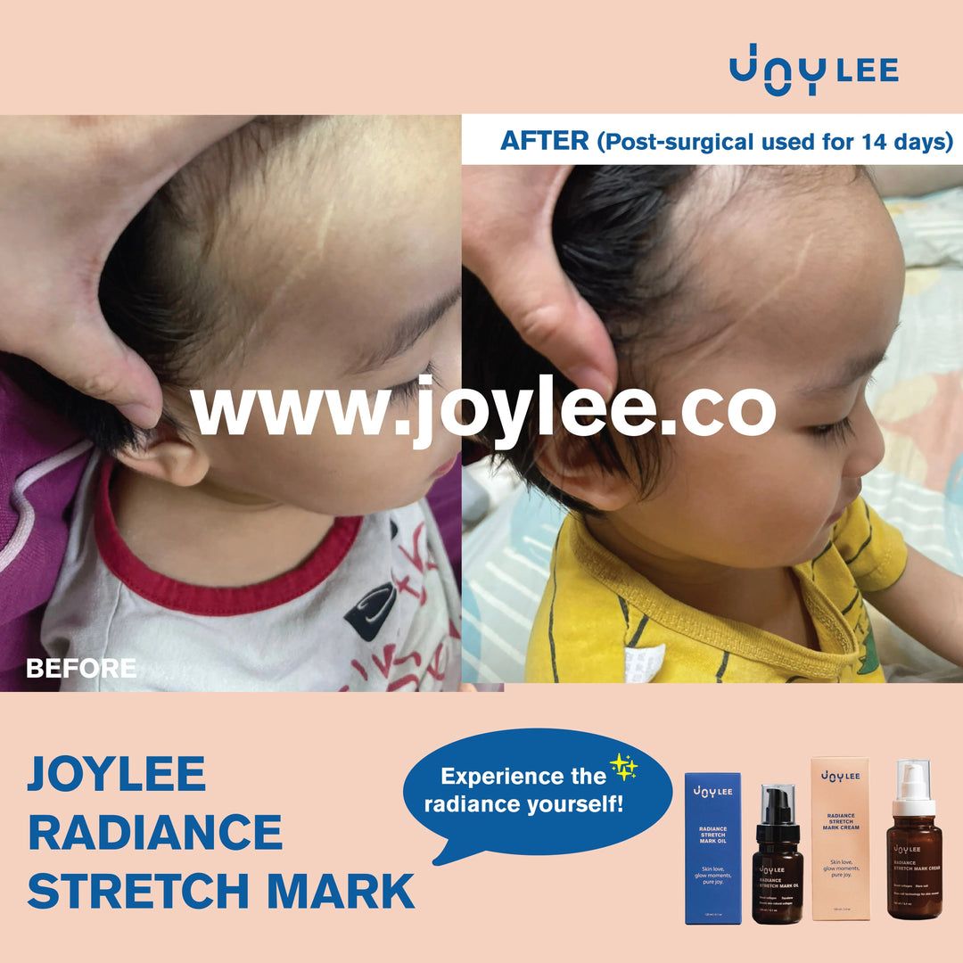 JOYLEE Radiance Stretch Mark Cream - 160ml