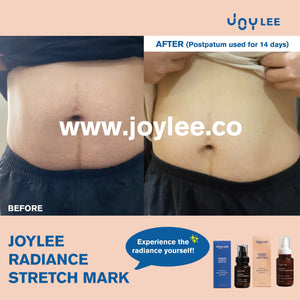 JOYLEE Radiance Stretch Mark Oil - 100ml
