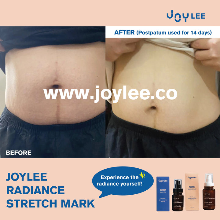 JOYLEE Radiance Stretch Mark Cream - 160ml