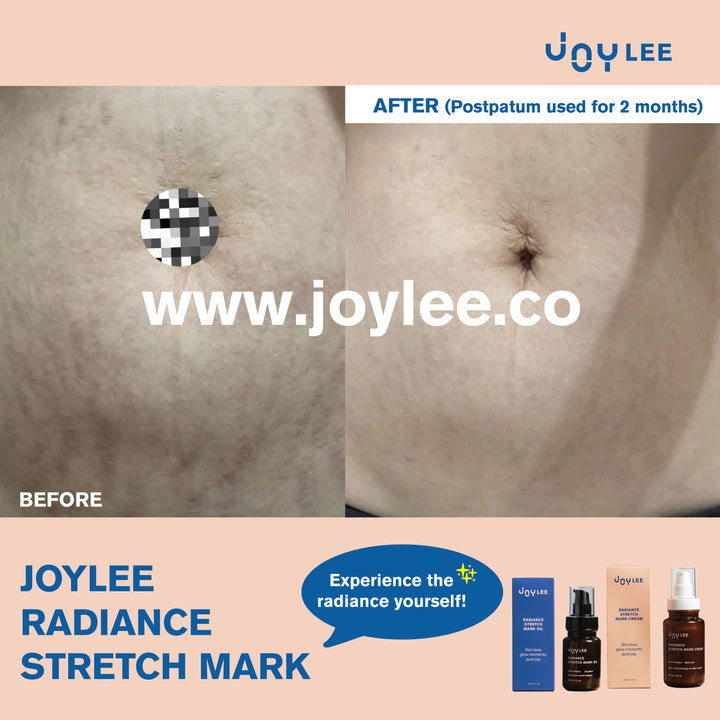JOYLEE Radiance Stretch Mark Cream - 160ml